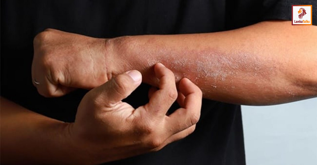 Hot weather: Dermatologists warn of skin conditions