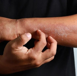 Hot weather: Dermatologists warn of skin conditions