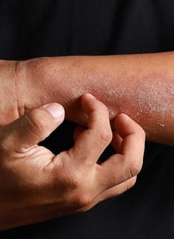 Hot weather: Dermatologists warn of skin conditions