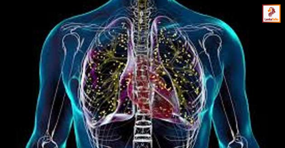 Thousands of TB cases remain undetected in Sri Lanka: WHO