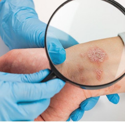 Skin cancer takes the spotlight